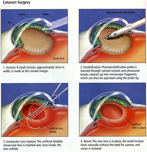 Cataract Surgery and Treatment