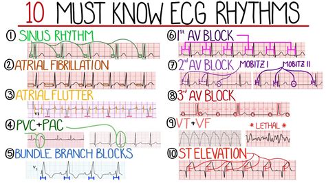 Common EKG Patterns