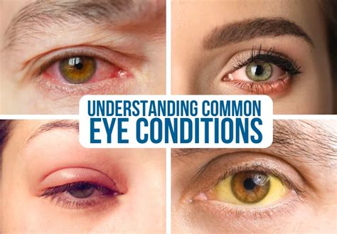 Common Eye Conditions Treated