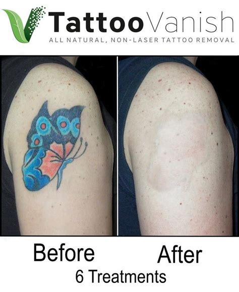 Cost of Tattoo Removal