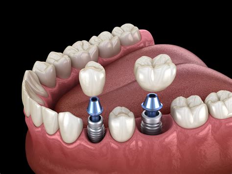 Dental Implants at Excel Dental Haverhill Smiles