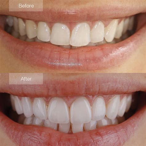 Dental Veneers