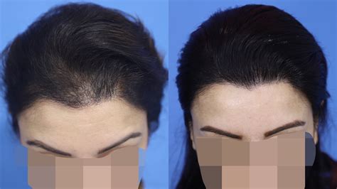 Hair Growth Results with Rogaine