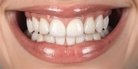 Introduction to Teeth Whitening