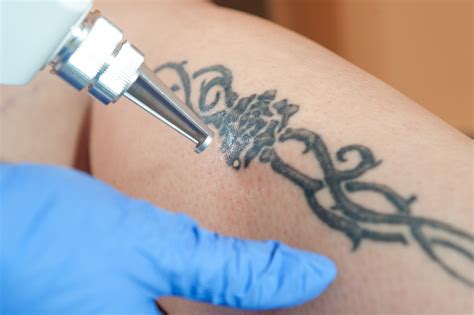 Laser Tattoo Removal