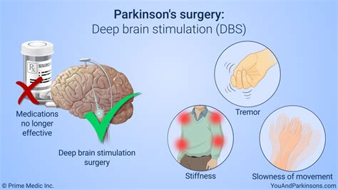 Description of Parkinson's Disease Treatment