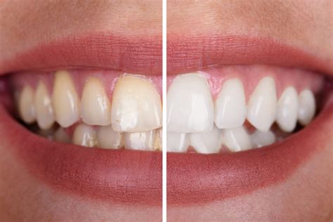 Professional Teeth Whitening