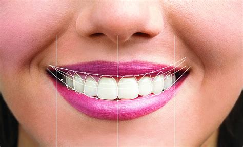 Smile Design at Excel Dental Haverhill Smiles