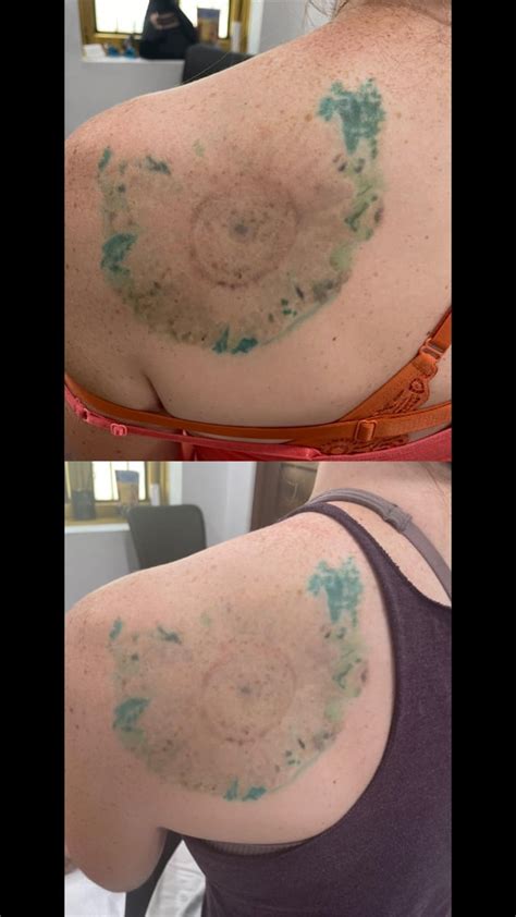 Tattoo Removal In Green Bay Wi