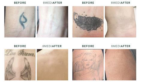 Tattoo Removal Methods