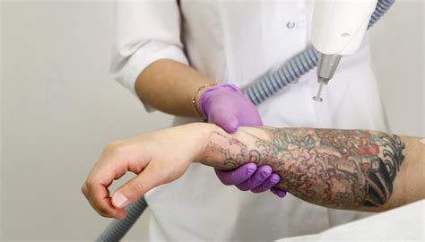 Tattoo Removal Services