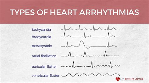 Arrhythmias