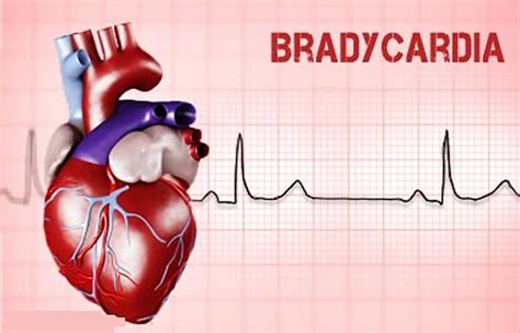 Bradycardia