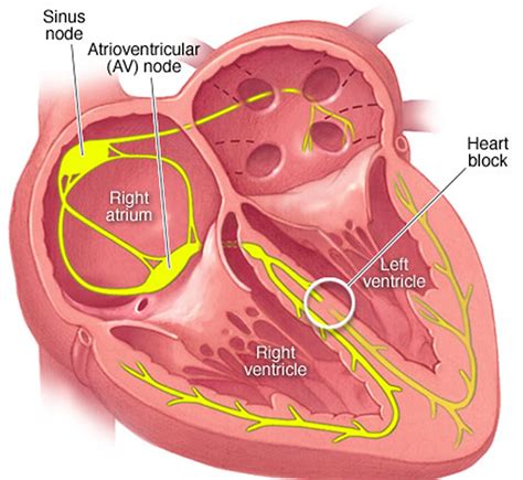 Bundle Branch Blocks EKG