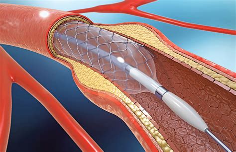 Description of cardiac cath procedure