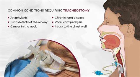 Common tracheostomy care challenges