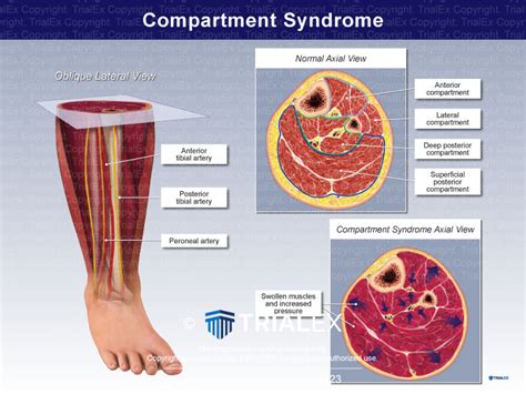 Compartment Syndrome Causes