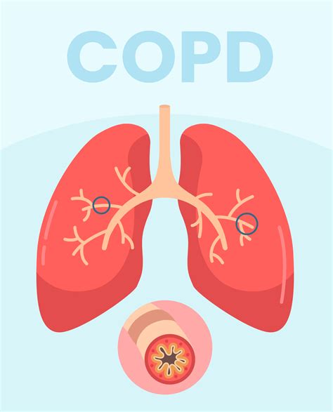 COPD lung image