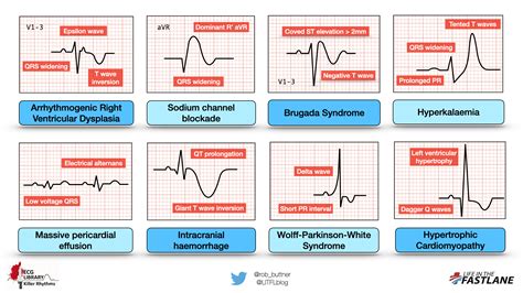 Common EKG Patterns