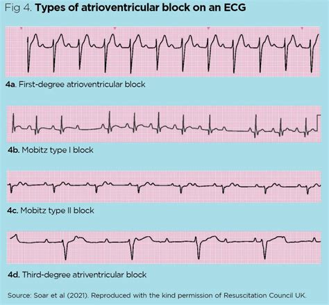 EKG Rhythm Abnormalities