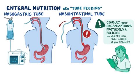 Enteral Feedings Procedure