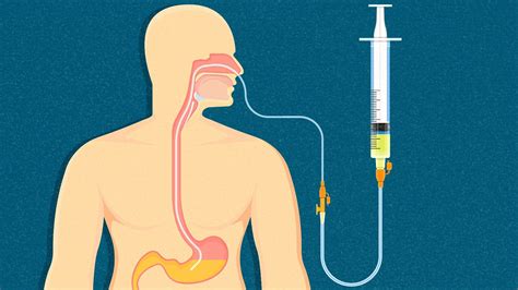 Enteral Feedings Administration