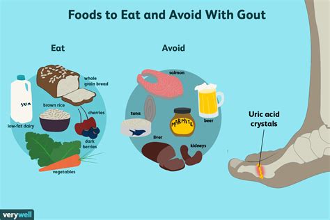 Gout diet image 1