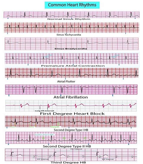 Normal and Abnormal Heart Rhythms