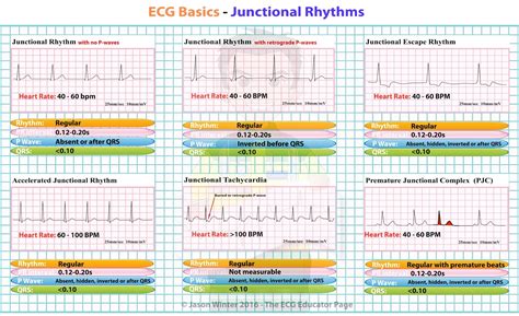 Interpretation of EKG Rhythms