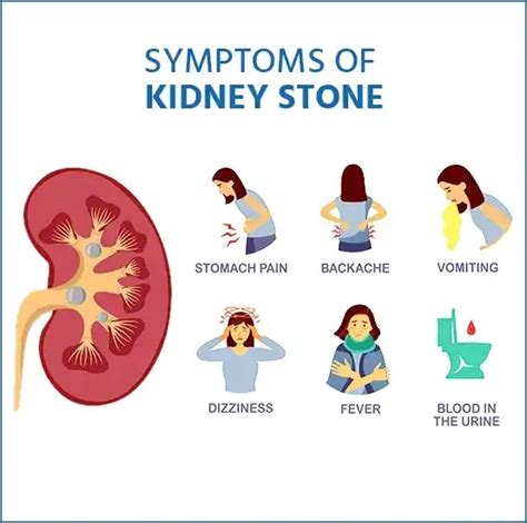 Kidney Stones