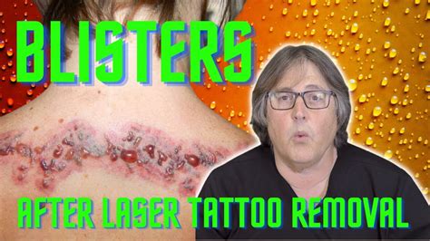 Laser tattoo removal blisters treatment