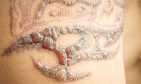 Laser tattoo removal side effects