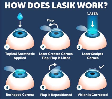 LASIK Surgery