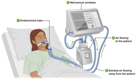 Mechanical ventilator