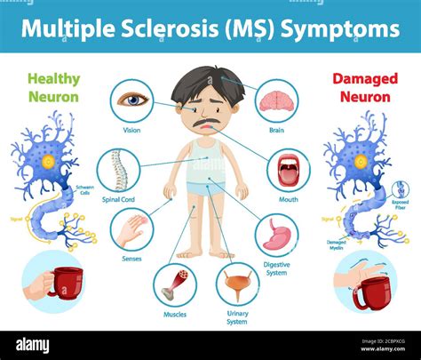 Multiple Sclerosis Symptoms