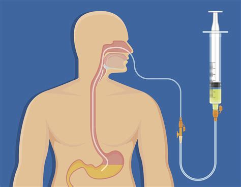 Nasogastric Intubation Procedure