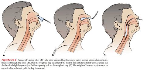 Nasogastric Intubation Special Populations