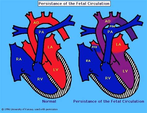 Description of PPHN Awareness