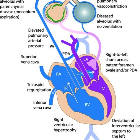 Description of PPHN Prevention