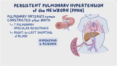 Description of PPHN Symptoms