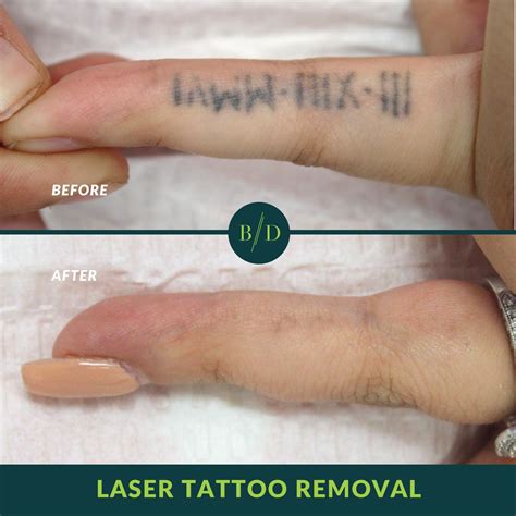 Surgical tattoo removal