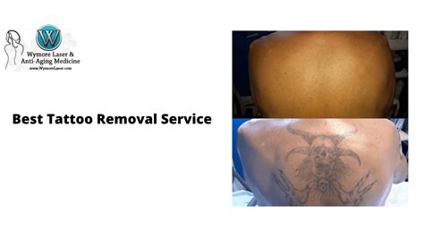 Tattoo Removal Near Me In Bradenton Fl