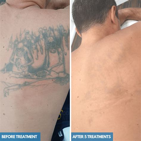 Tattoo removal risks and complications