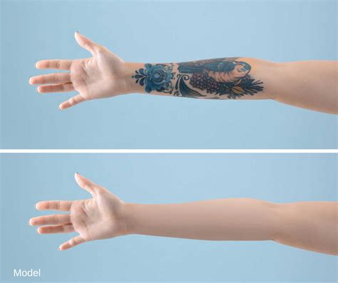 Tattoo removal step-by-step