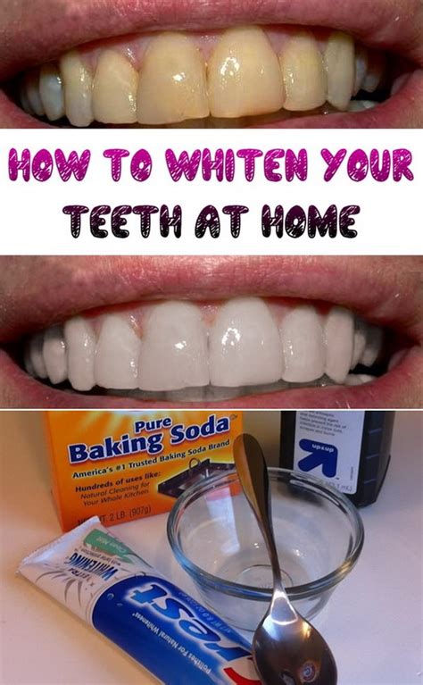 Teeth Whitening at Home