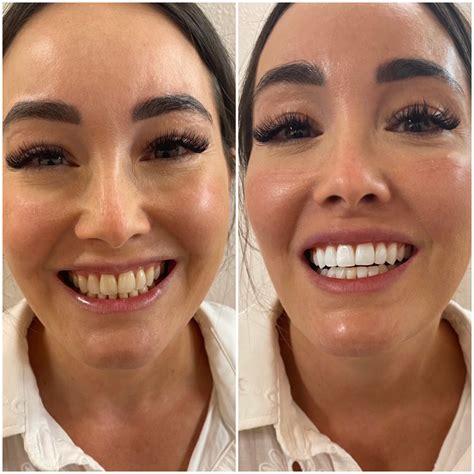 Teeth Whitening Before and After