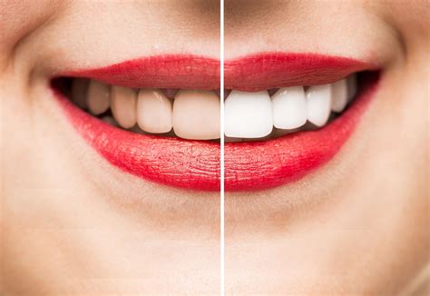 Teeth Whitening Maintenance