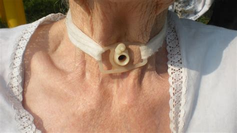 Tracheostomy care image 10