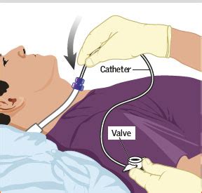 Tracheostomy care image 8