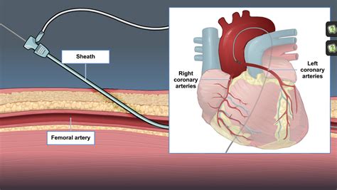 Description of understanding cardiac cath